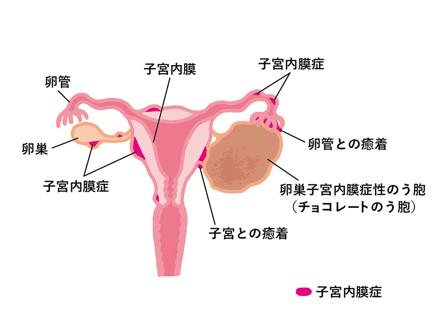 子宮内膜ポリープ手術体験談｜痛みや費用・術後経過と妊娠への影響