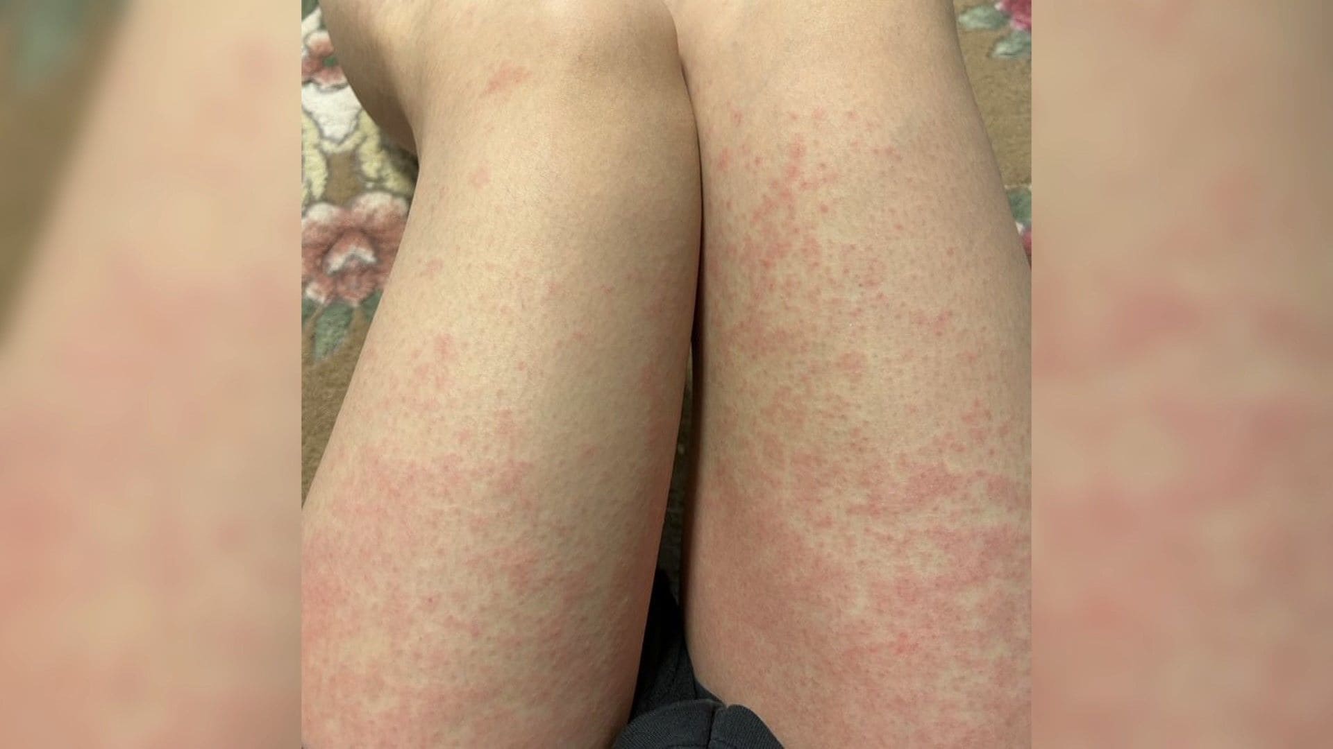 冬の突然の痒みはなぜ？寒暖差と乾燥が招く蕁麻疹の正体と治し方