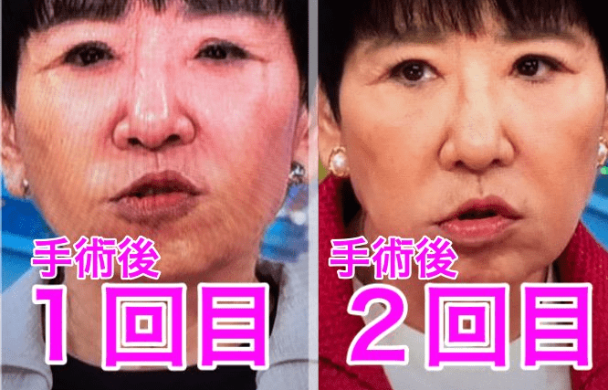 【2026年最新解説】和田アキ子が明かした眼瞼下垂との闘い――「見えにくさ」の限界と向き合った真実