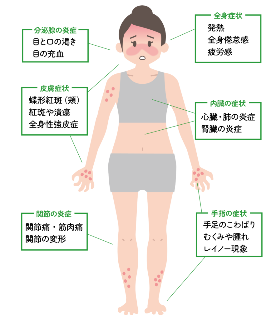 膠原病とは？見逃せない初期症状と原因・2026年最新治療の真実