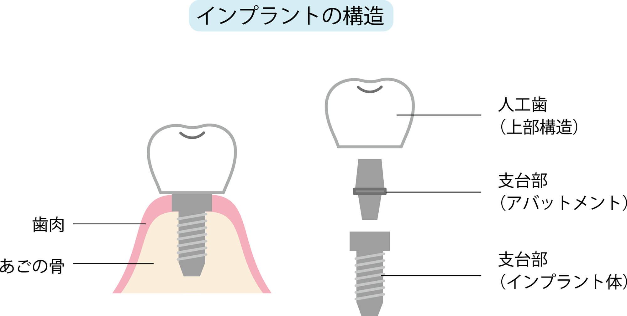 ワンピースインプラントの罠？安さと手軽さの裏にある失敗リスク