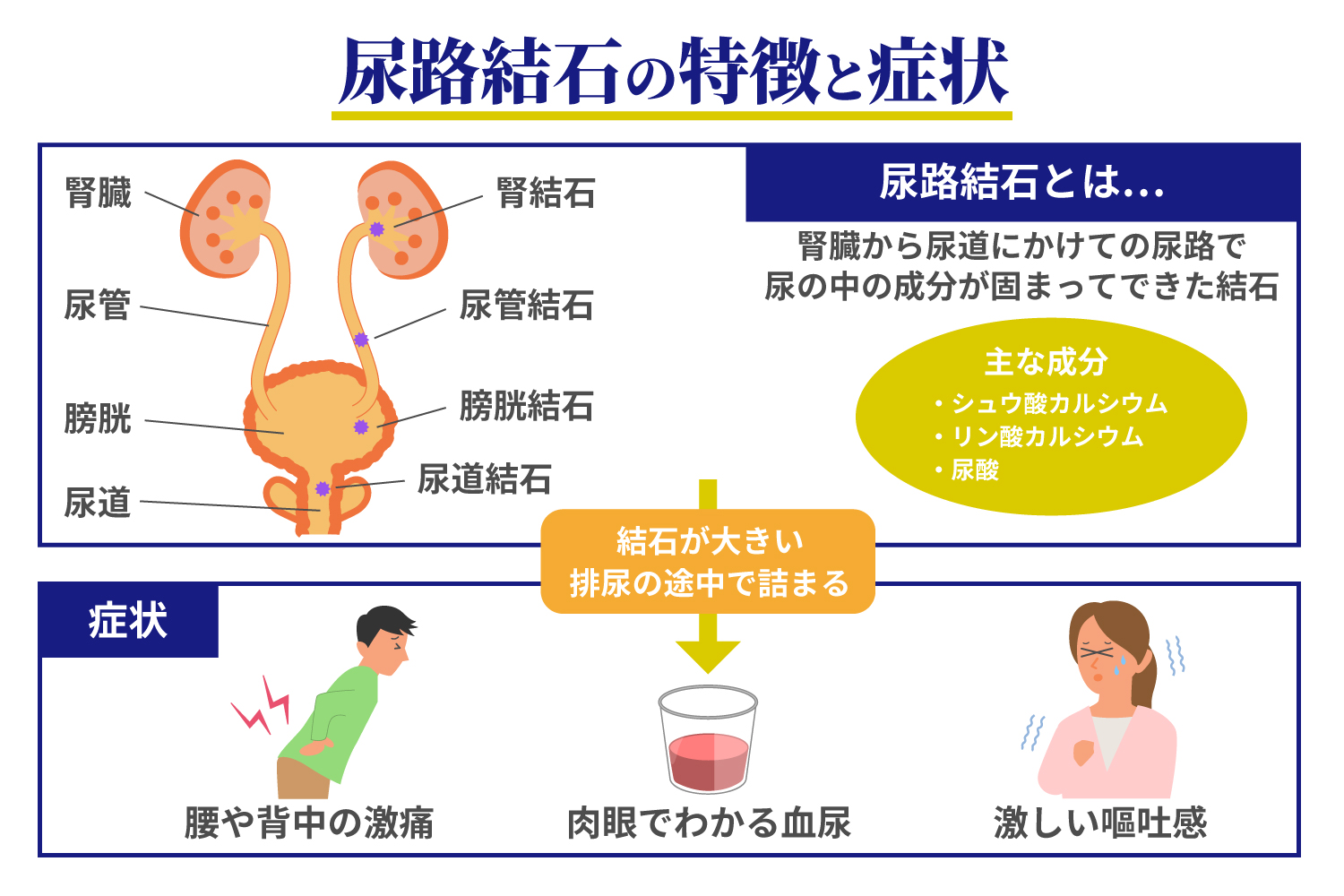 膀胱結石の症状と前兆サイン｜排尿痛や血尿の真相と治療法を徹底解説