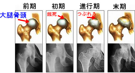 【動画まとめ】 大腿 骨頭 壊死 芸能人 インスタライブ最新動画 #868