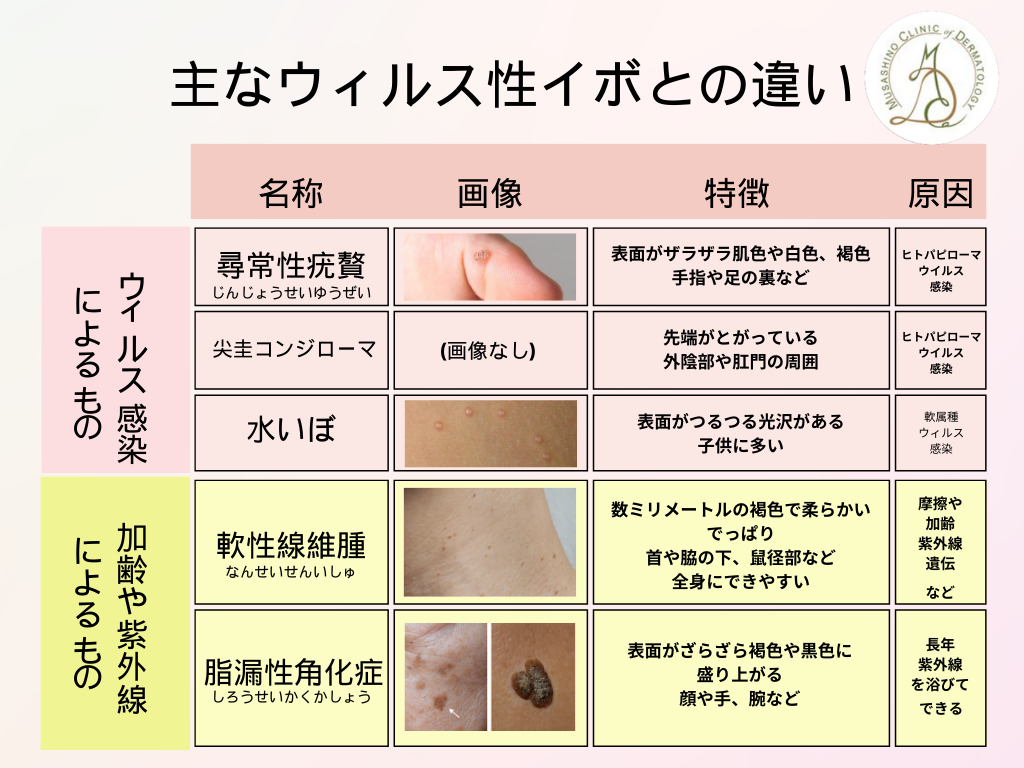 イボは「皮膚科」で診てもらうのが最短ルート 放置リスク・治療費・痛みのリアルまで総点検