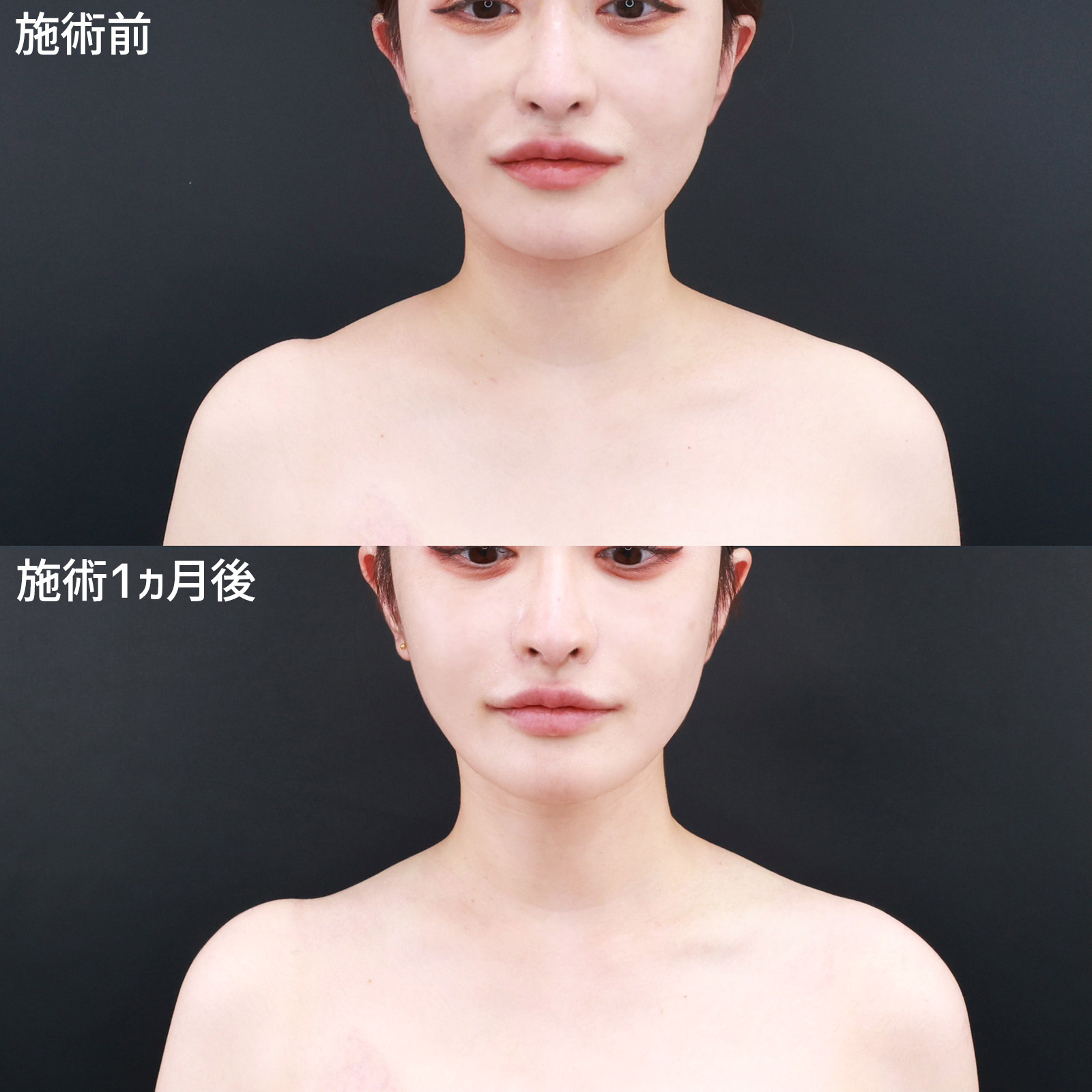 首を長くする方法の真相｜姿勢改善と僧帽筋ケアでデコルテを劇的再生