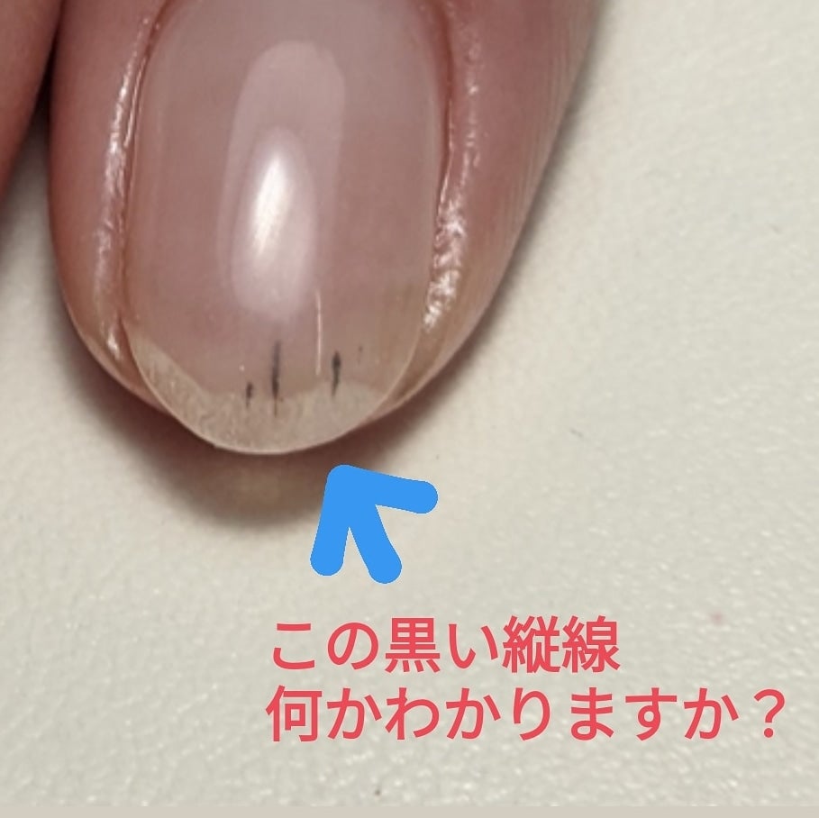 爪の真ん中に黒い線？放置禁物の理由と悪性黒色腫の最新見分け方