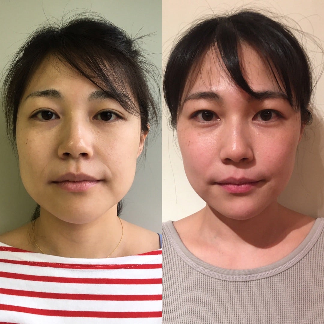 表情筋は鍛えない方がいい？顔トレでシワ・たるみが悪化する真相