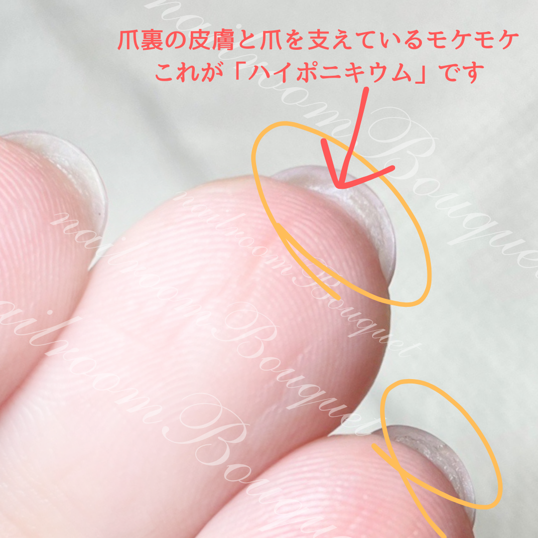 ハイポニキウム伸びすぎで切れない？痛い爪裏の皮膚の原因と戻し方