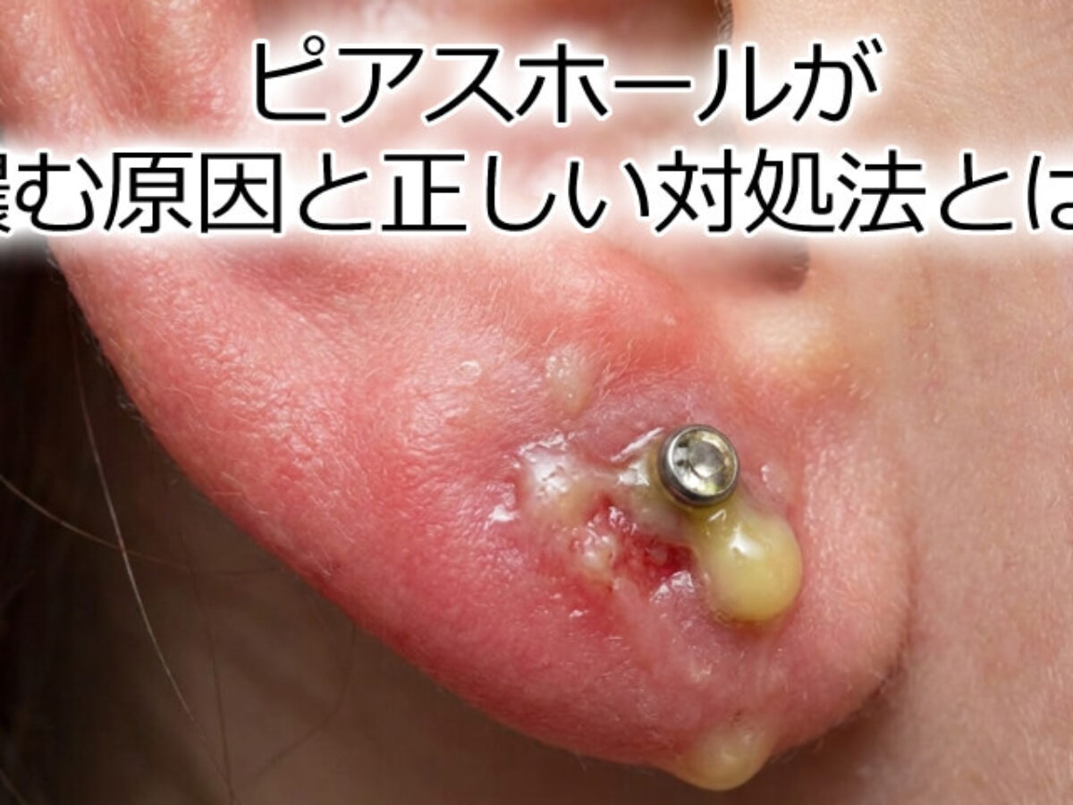 ピアスが膿んだ時の正しい治し方と危険なNg処置！外すべきかの判断基準