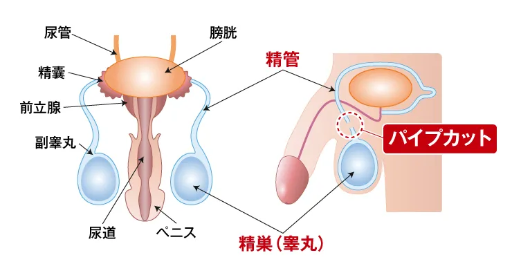 ペニスカットの真相と衝撃事件の全貌｜医療手術との違いも徹底解説