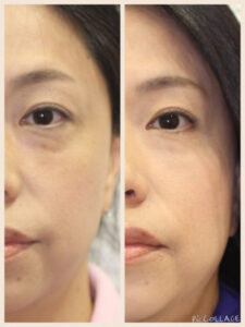 鏡を見るたび憂鬱になる「あの赤み」の正体。2026年最新皮膚科学が明かす、鼻ニキビが居座る本当の理由と劇的解決アプローチ