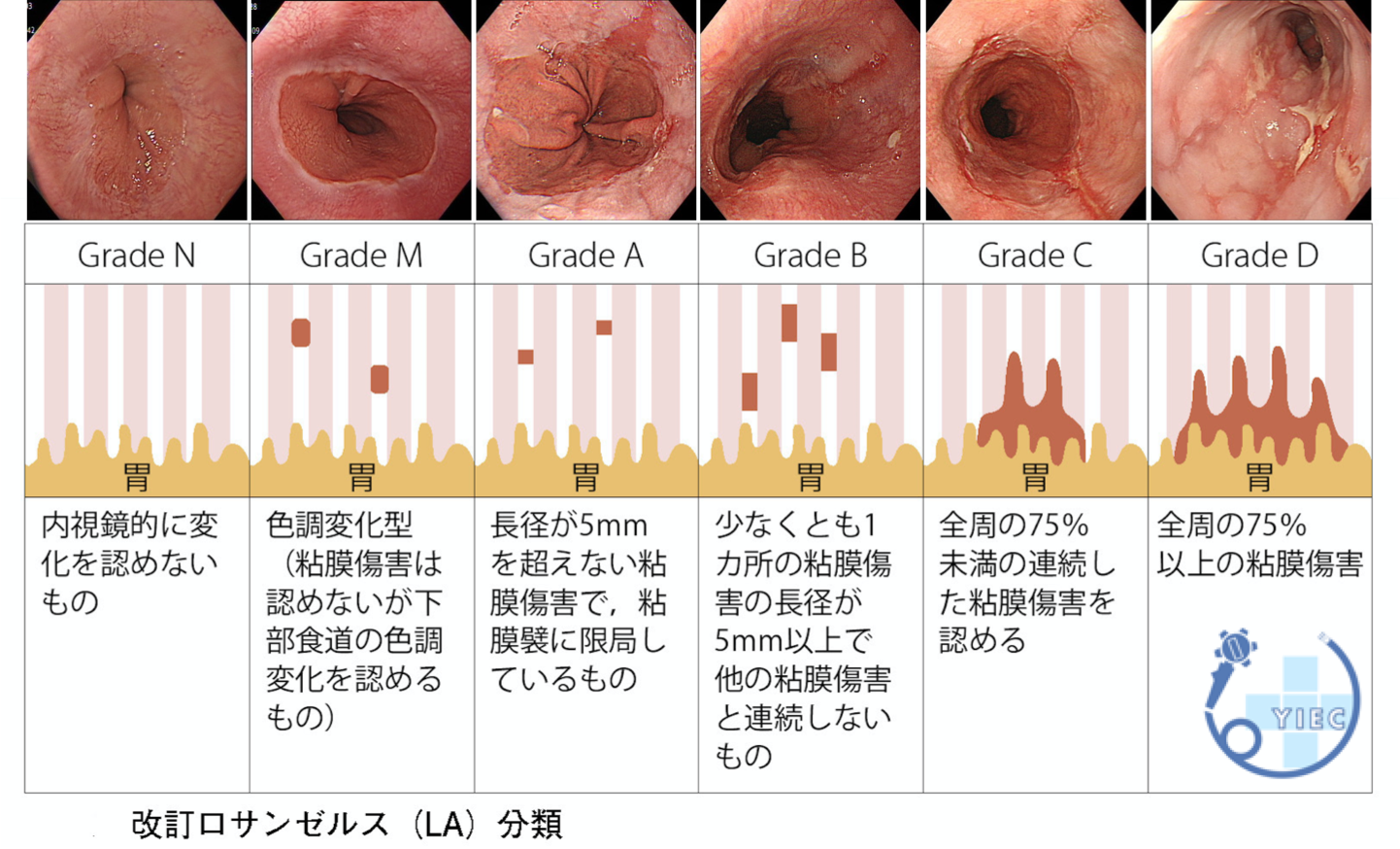 逆流性食道炎で息苦しい時の緊急対処法と楽になる姿勢を徹底解説