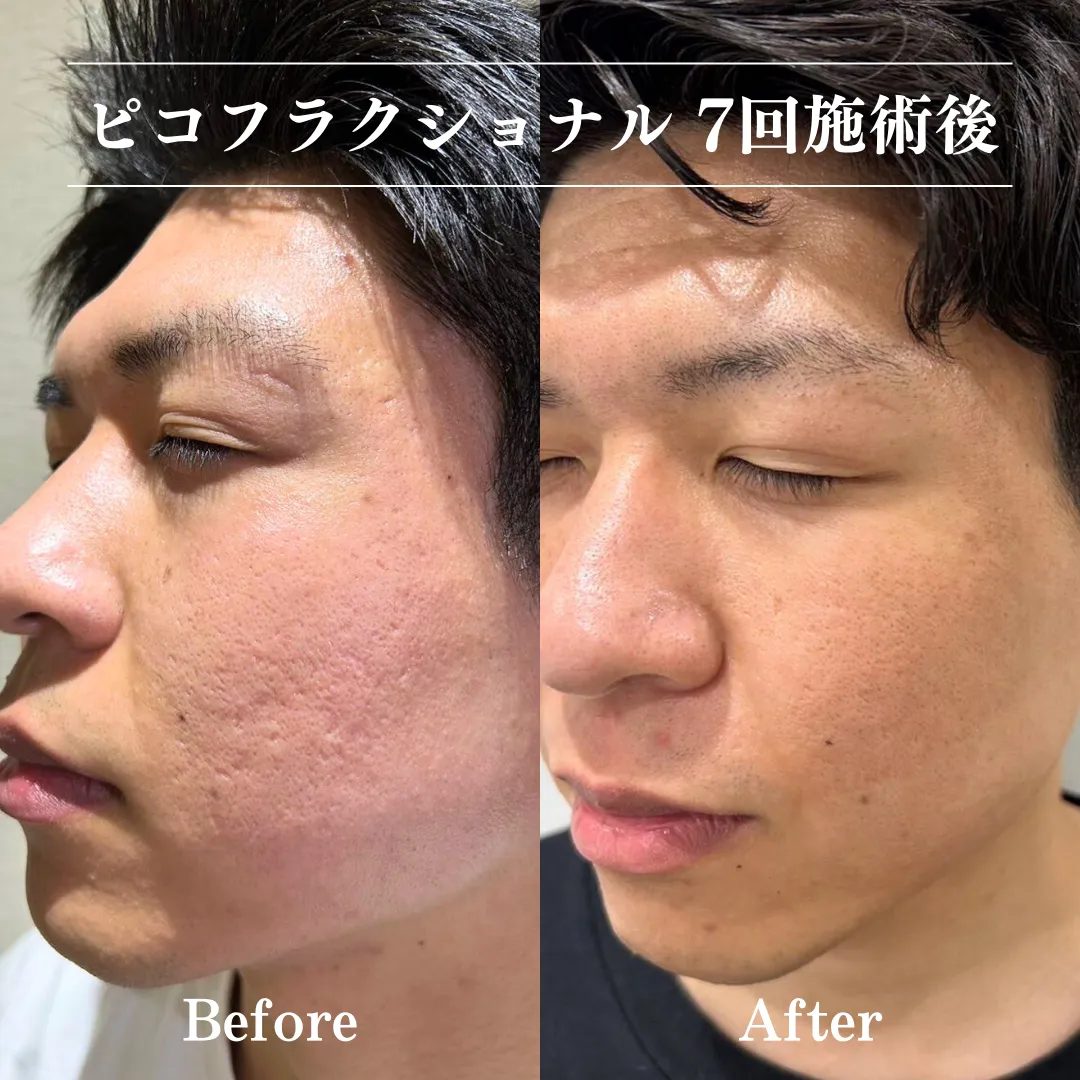 ピコフラクショナル効果の真実｜ダウンタイムと肌再生の意外な実態を徹底検証