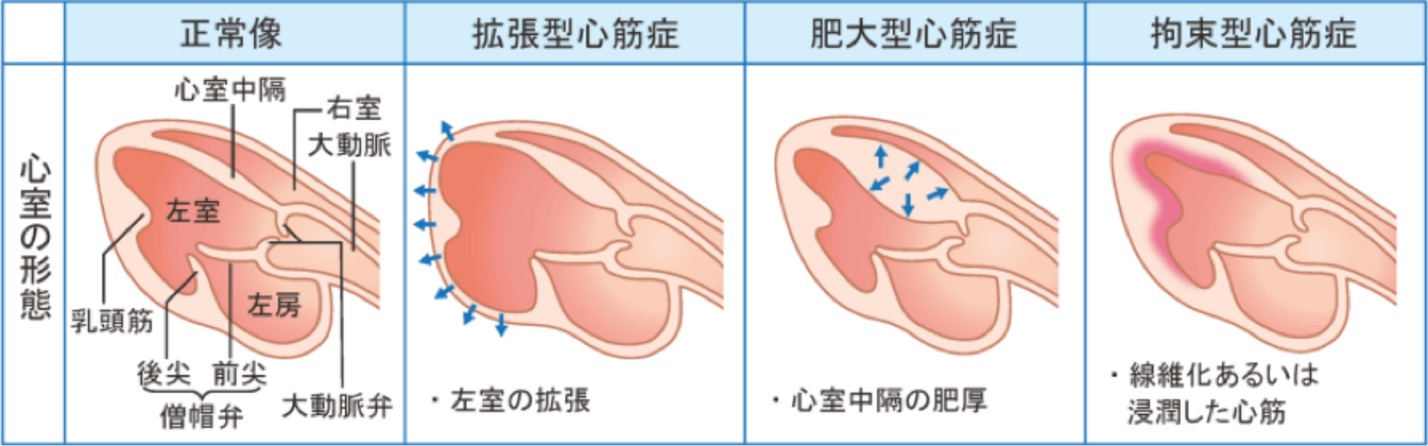 心臓肥大とは「心臓の筋肉が厚くなる」危険サイン…放置で心不全リスクが急上昇する理由