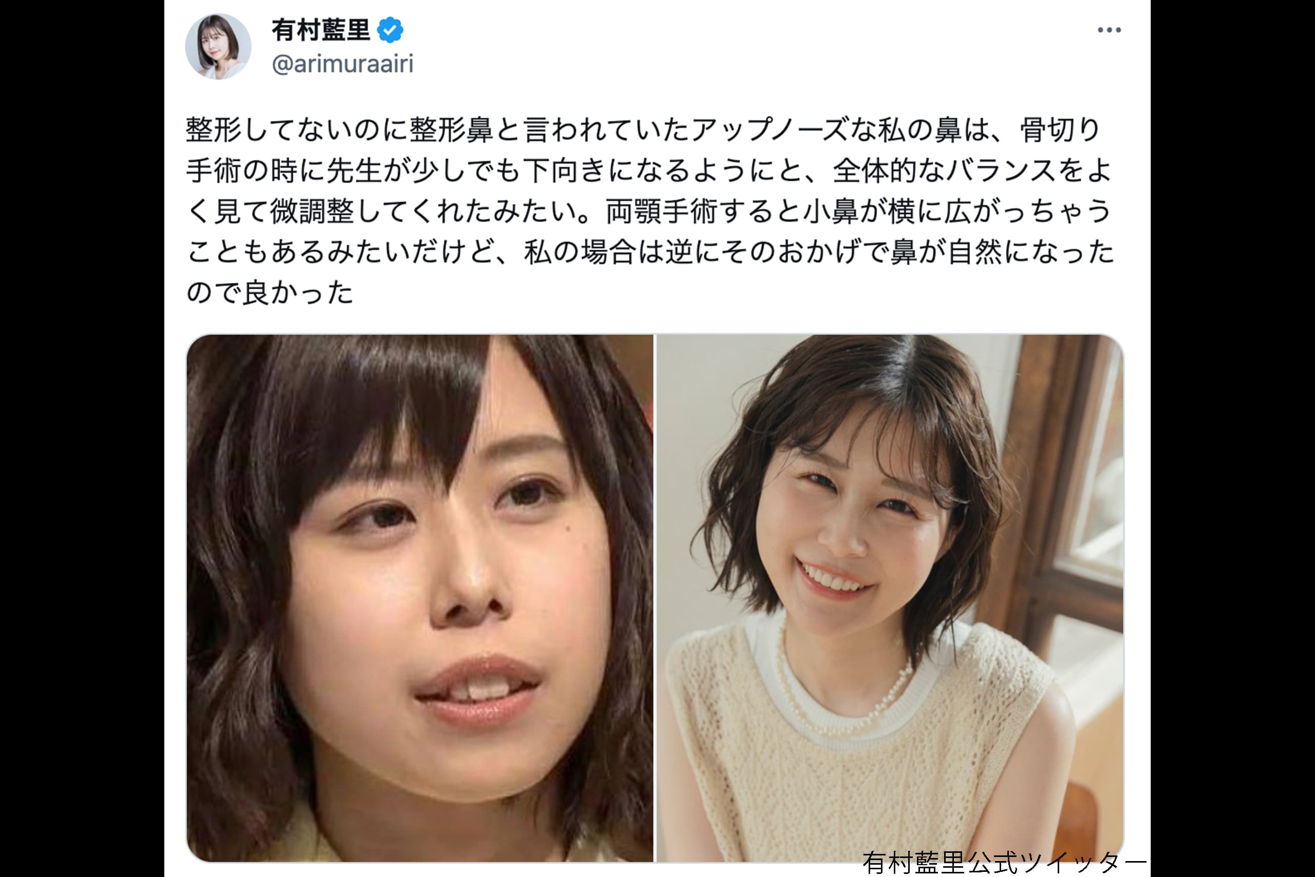 有村藍里の骨切り手術全貌｜劇的変化の理由と病院・費用・現在の姿