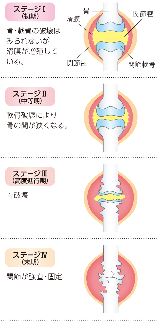 リウマチとは？朝のこわばりから始まる初期症状と2026年最新治療