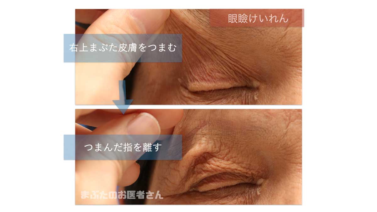 下まぶたの痙攣が止まらない原因は？危険な病気の見極め方と対処法
