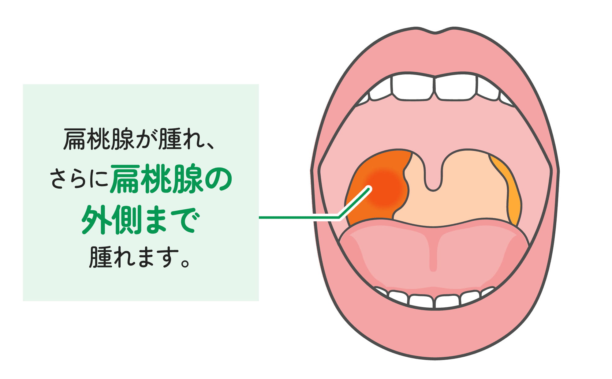 喉の腫れが治らない原因とは？熱なし・片側の危険サインと受診目安