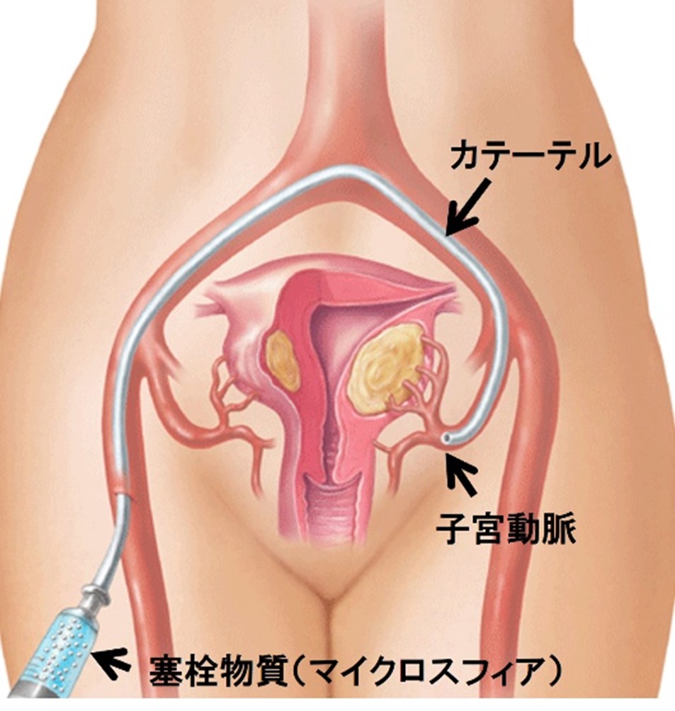 子宮動脈塞栓術Uaeの真実｜切らない治療の効果と痛みの限界を検証