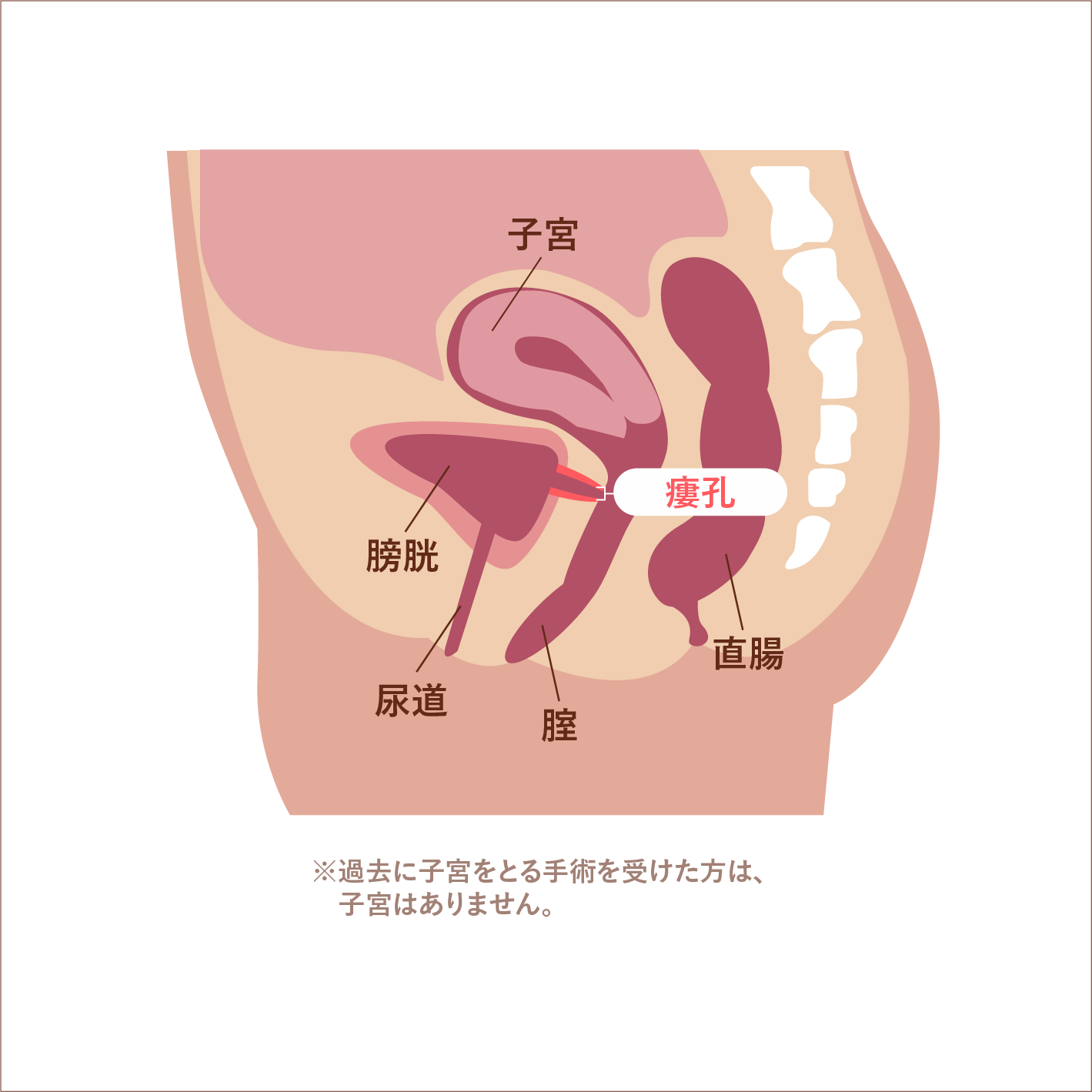 膀胱瘻とは？尿道カテーテルとの違い・交換頻度や日々のケアを徹底解説